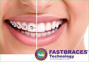 Fast Braces